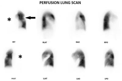 Pulmonary artery stenosis in Takayasu disease mimicking pulmonary embolism on perfusion lung scan: A case report